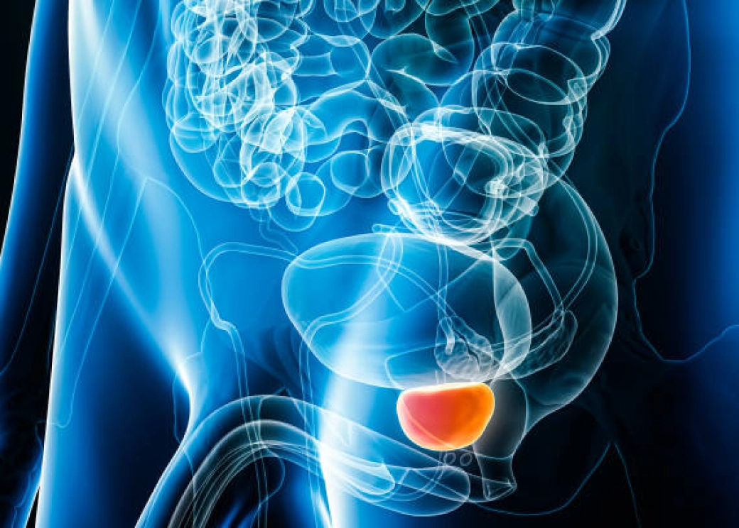 cancer de prostata